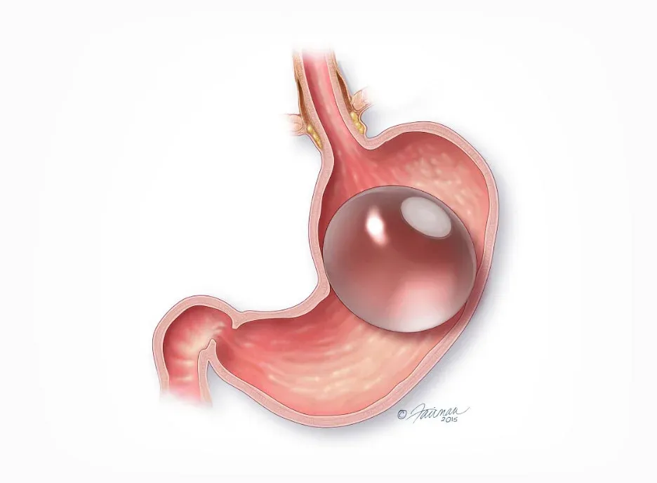 Medical illustration of an endoscopic balloon in a patient's stomach