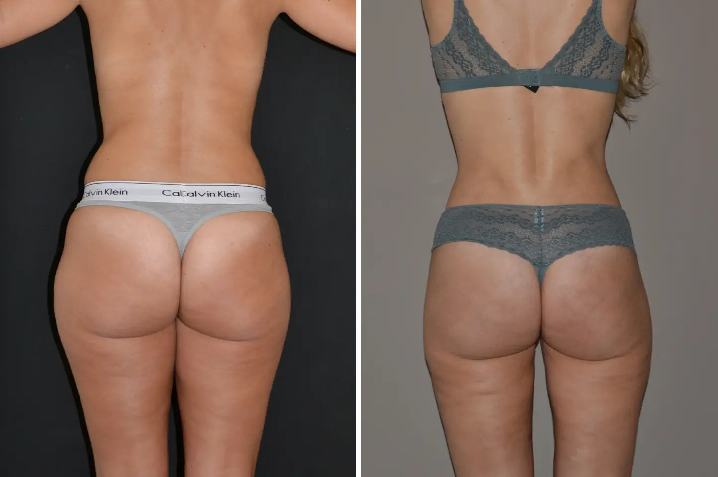 female liposuction before (left) and after (right), back view