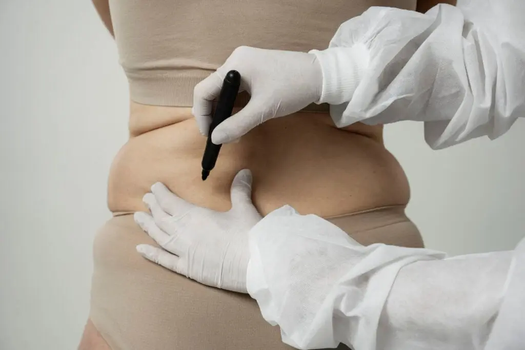 A woman who will undergo liposuction surgery.