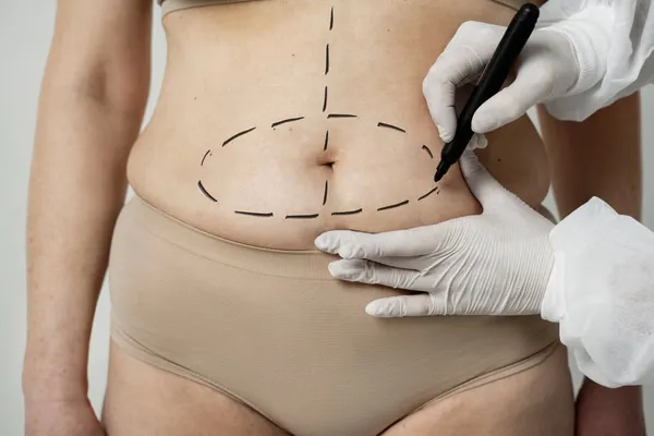 How a Tummy Tuck Can Help You Achieve Your Dream Abdomen
