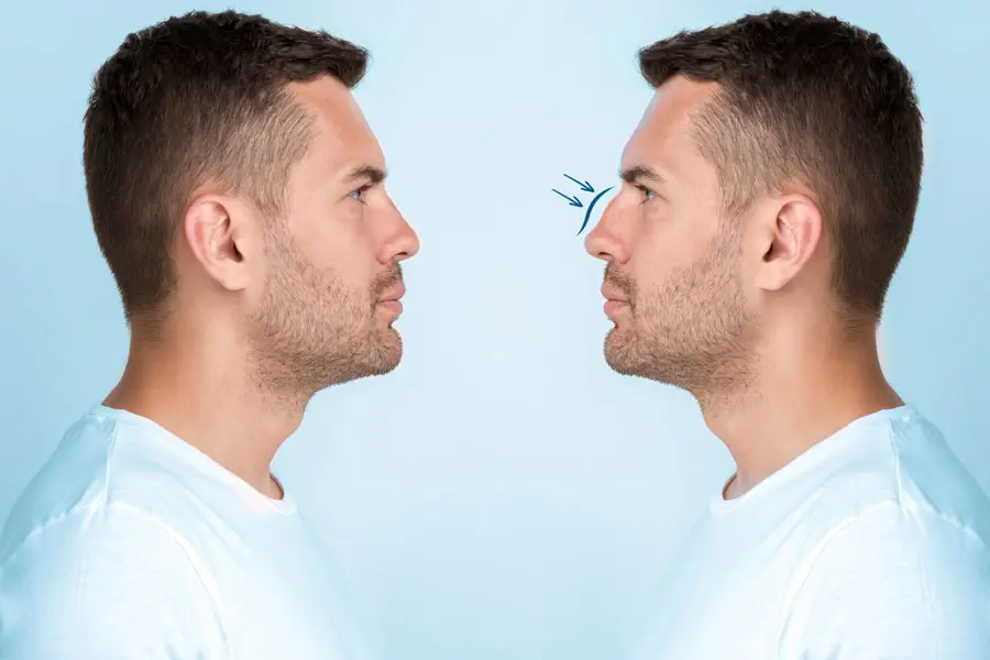 The effectiveness of Male Rhinoplasty