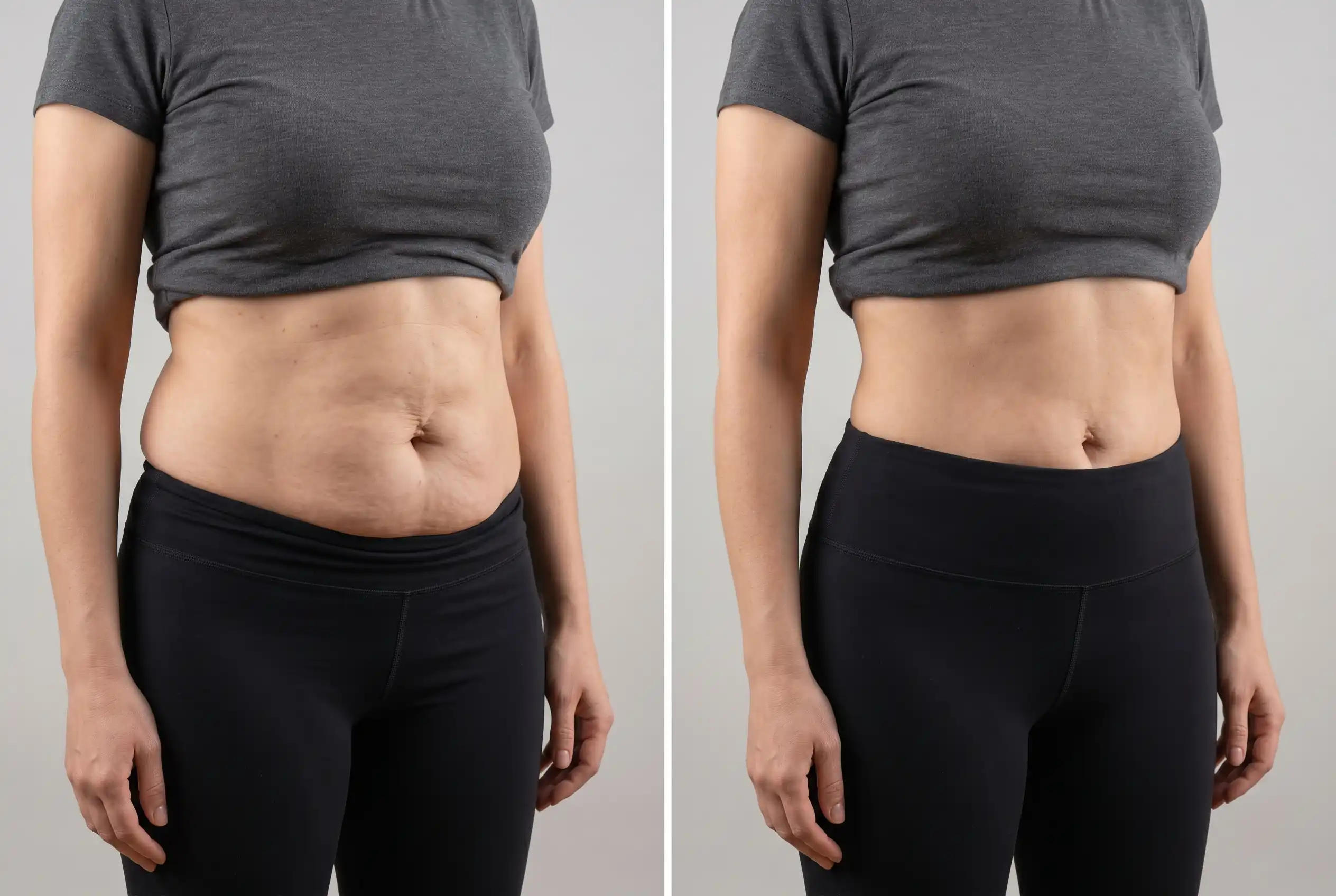 Before and after mommy makeover combining a tummy tuck and breast lift