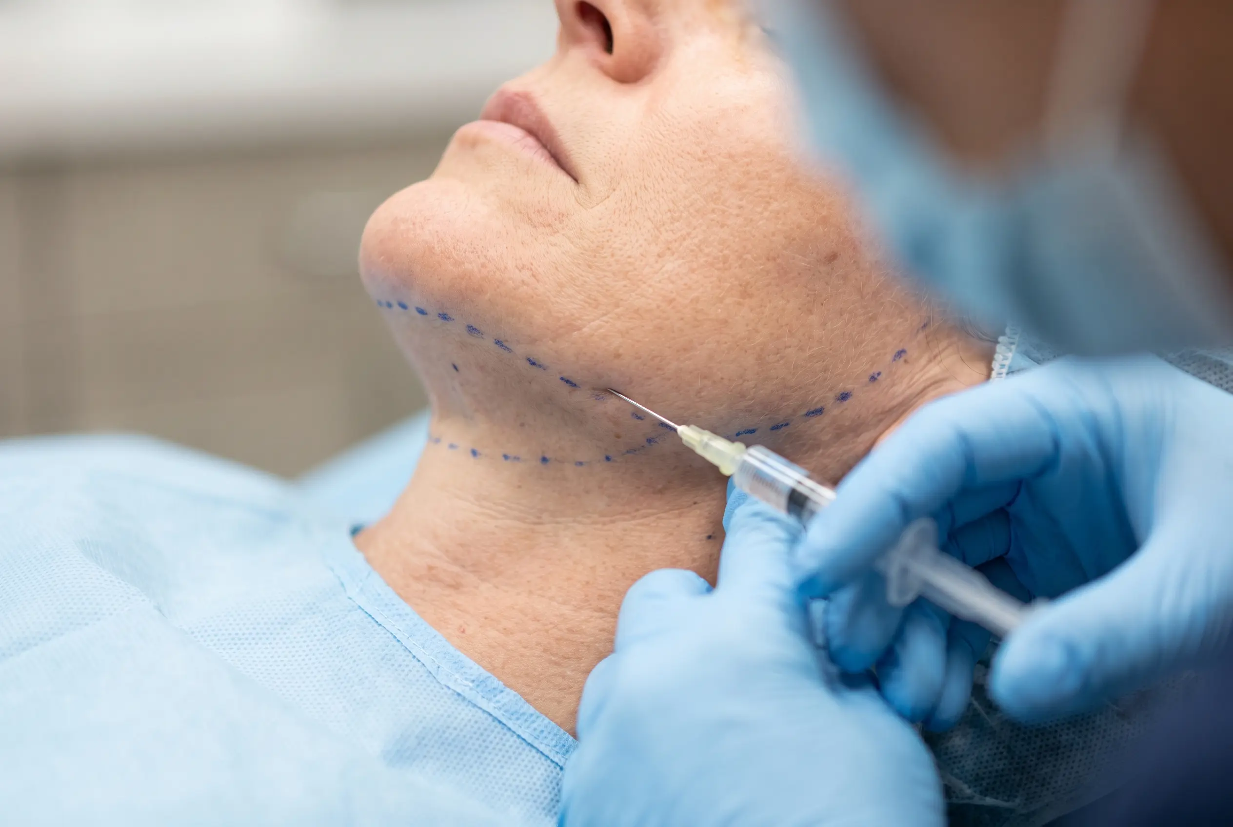 Tumescent numbing solution infiltrated along the jawline before awake FaceTite