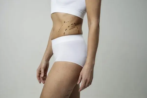 A woman with marker traces for liposuction.