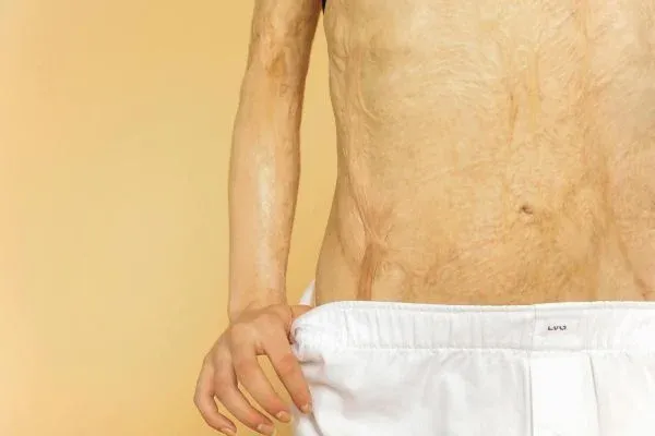 A woman with marker traces for liposuction.