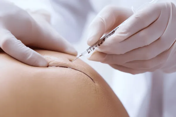 Standard Liposuction Process
