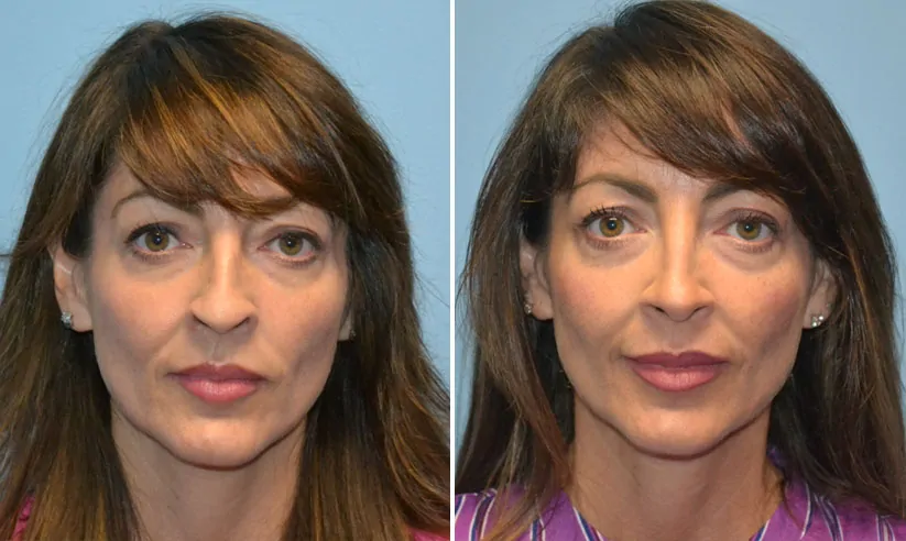 Female rhinoplasty before (left) and after (right), front view
