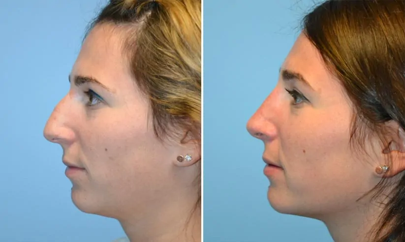 Male rhinoplasty before (left) and after (right), side view