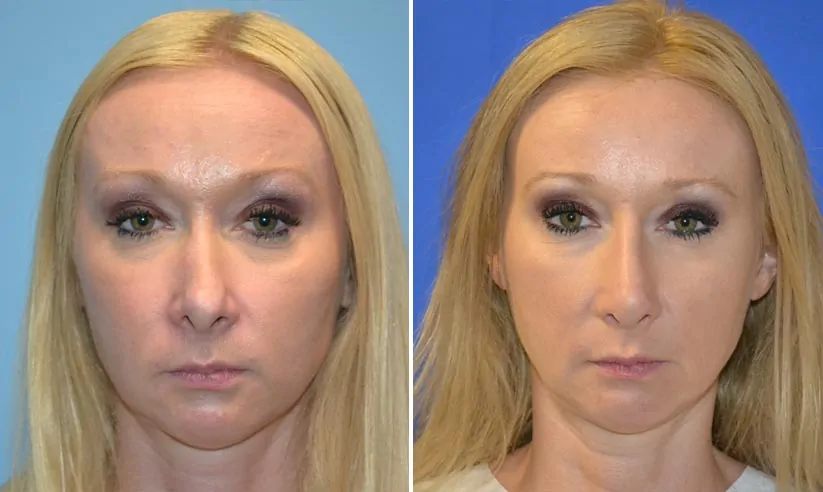 Female rhinoplasty before (left) and after (right), front view