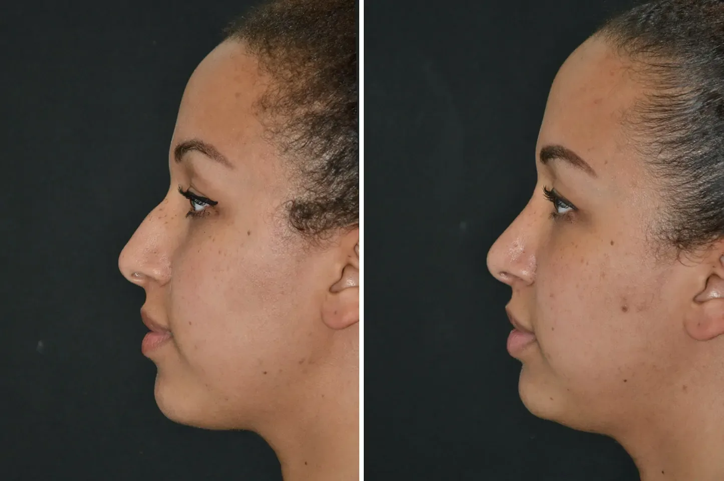 Female rhinoplasty before (left) and after (right), side views