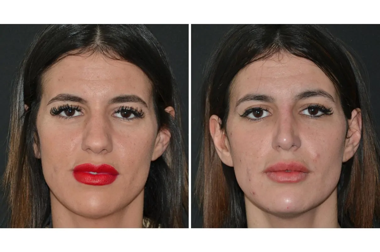 Female rhinoplasty before (left) and after (right), front view