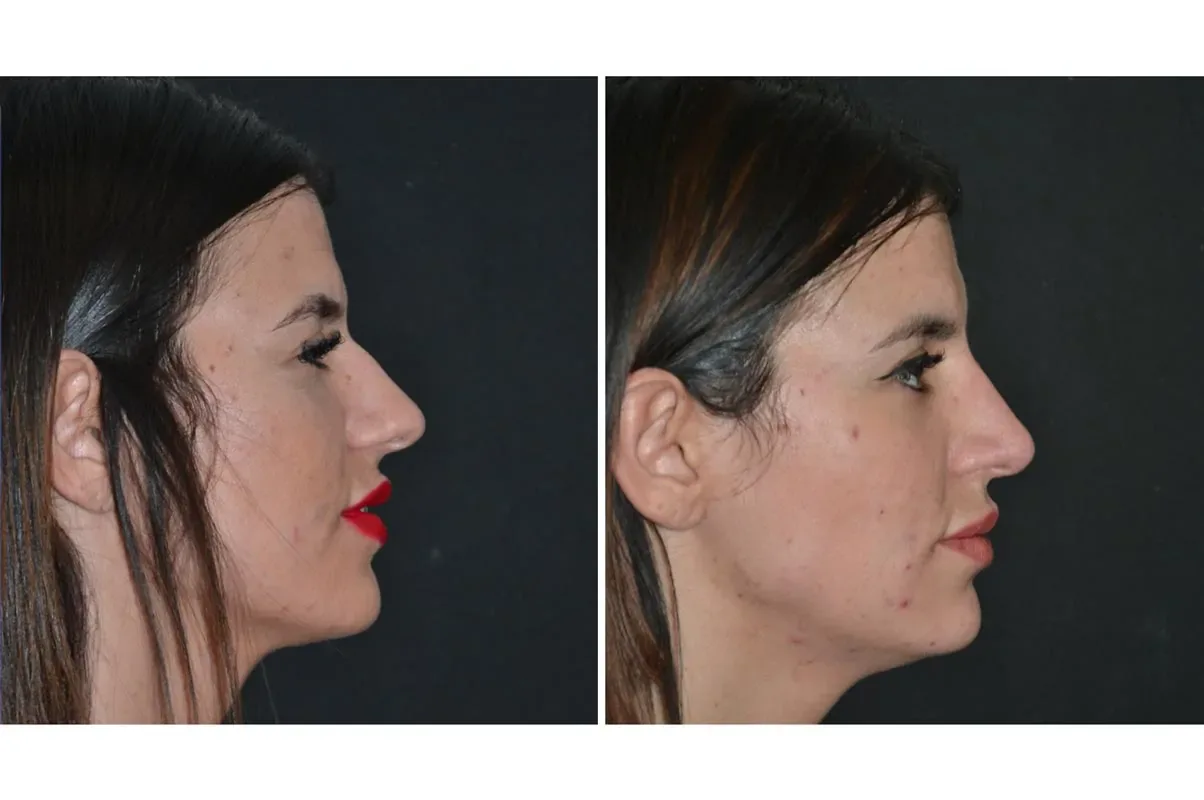 Male rhinoplasty before (left) and after (right), side view