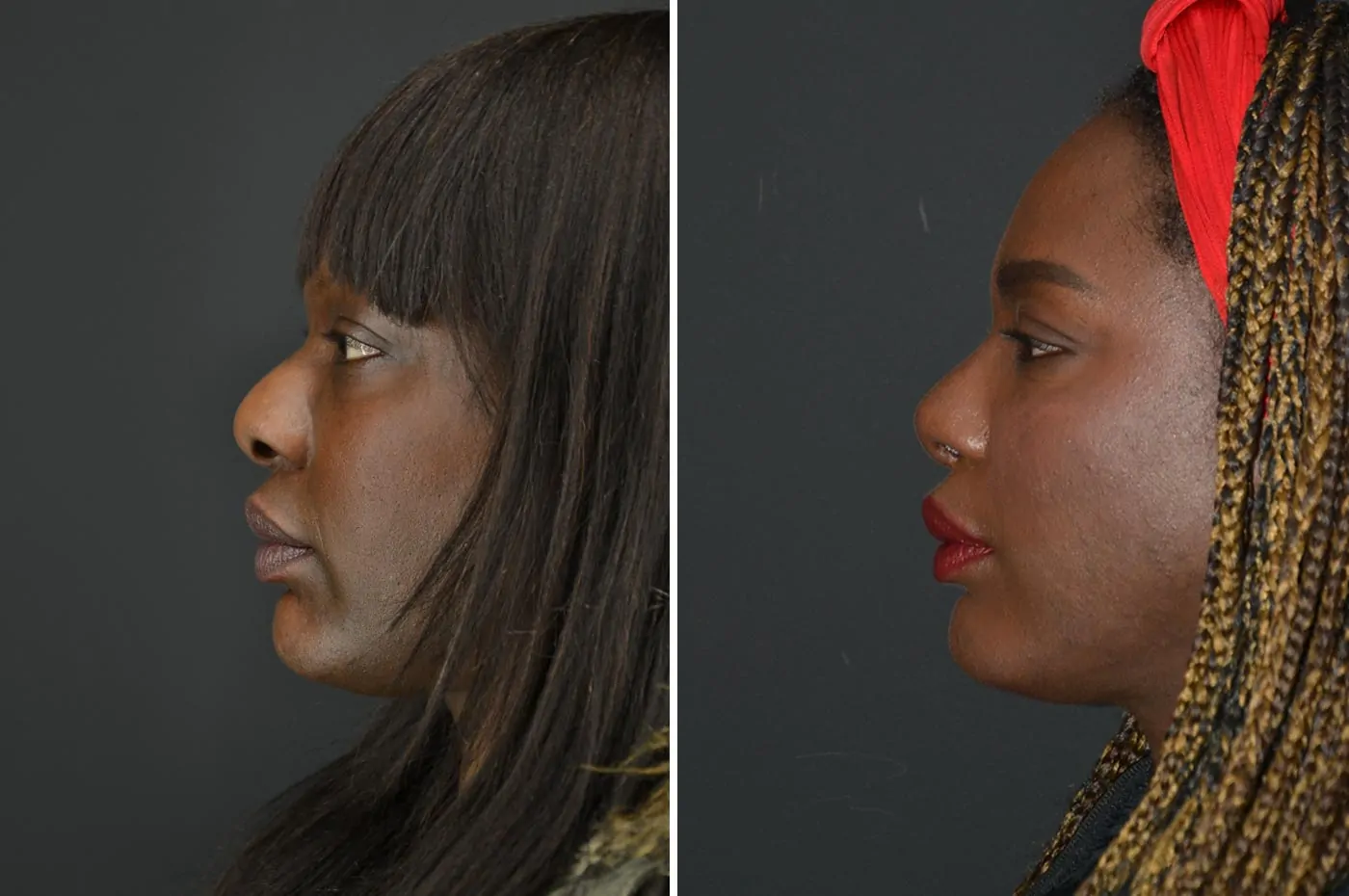 Female rhinoplasty before (left) and after (right), side view